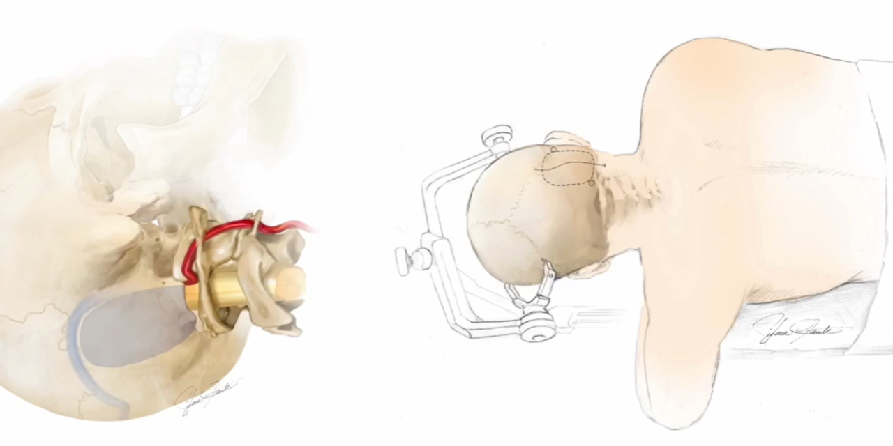 Awake surgery for intrinsic cerebellar tumor involving the middle cerebellar peduncle